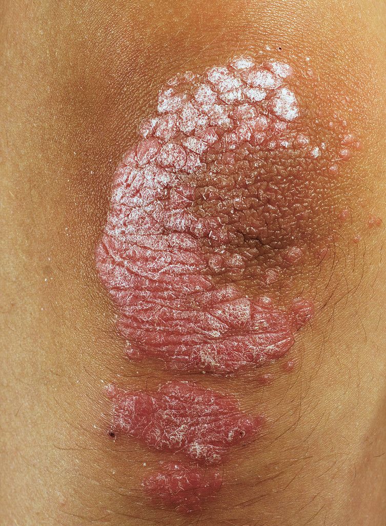 psoriasis skin disorder on an elbow