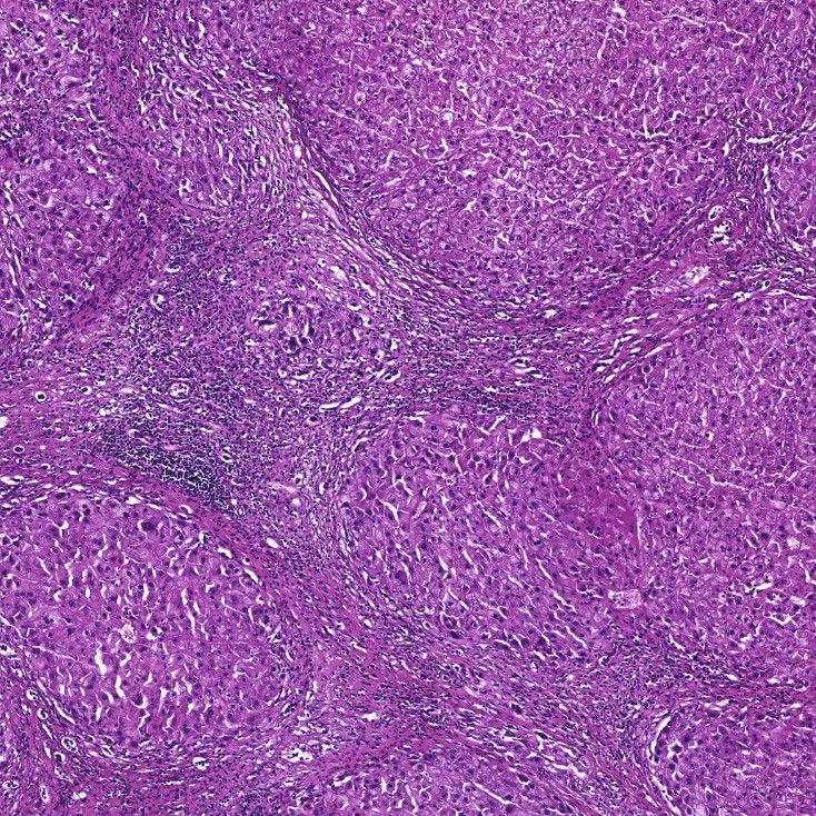 Neuer Therapieansatz für schwere alkoholbedingte Leberentzündung