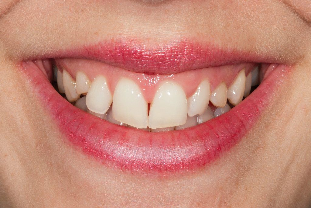 Wie der natürliche Zahn