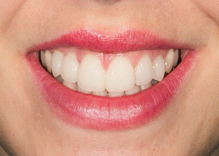 Wie der natürliche Zahn