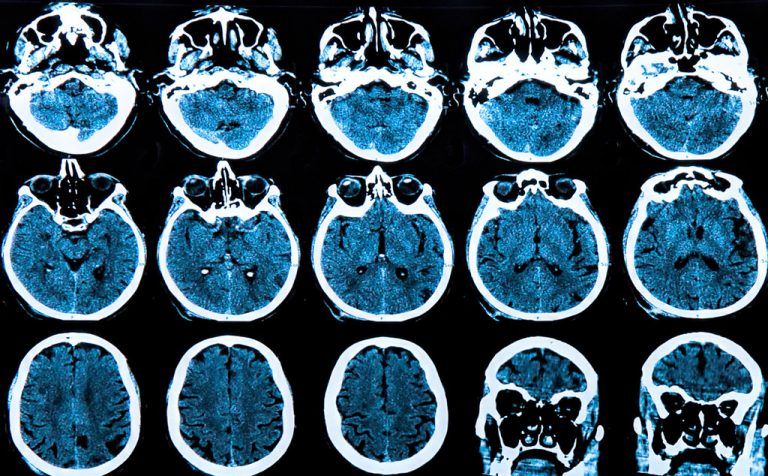Morbus Parkinson wird durch das Absterben bestimmter Nervenzellen im Gehirn verursacht.