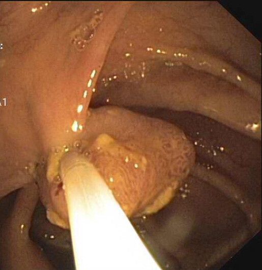Polypen sind der Nährboden, auf dem Krebszellen ideale Bedingungen zum Wachsen vorfinden. Deshalb müssen sie frühzeitig raus.vn