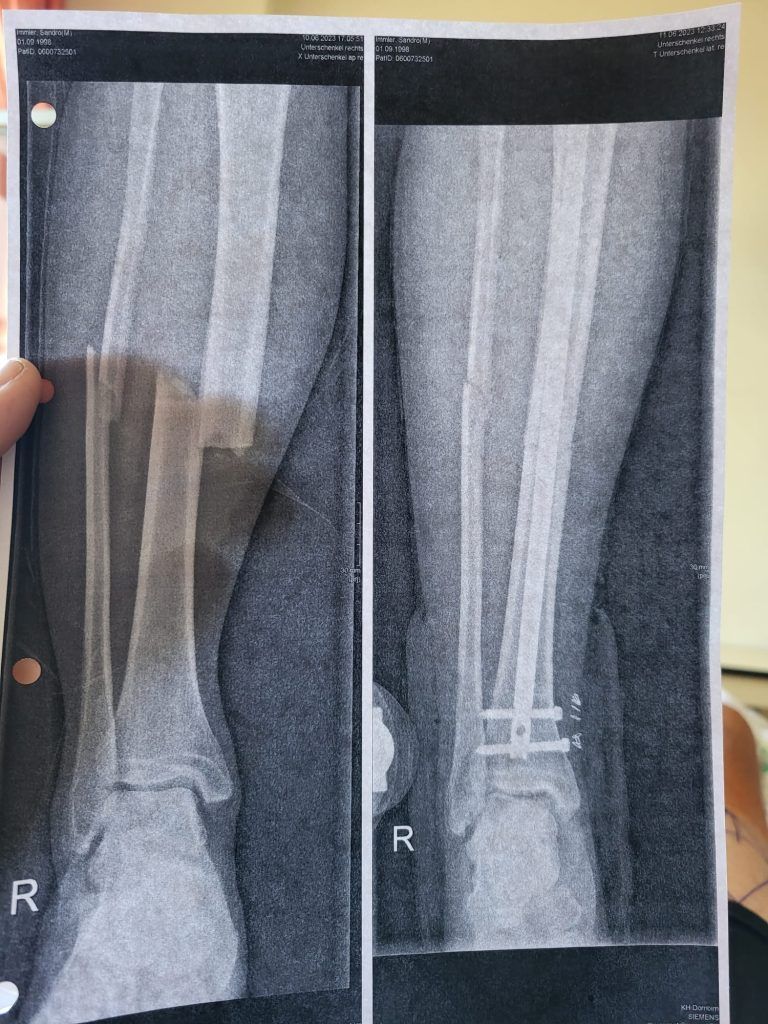 Die Röntgenbilder des rechten Beins von Sandro Immler. Links die Brüche, rechts der Metallstab im Schienbein gut zu erkennen.