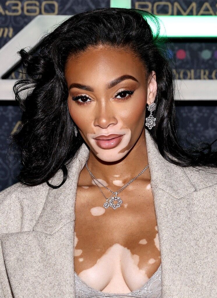 Winnie Harlow hat ihre Haut zum Markenzeichen gemacht.