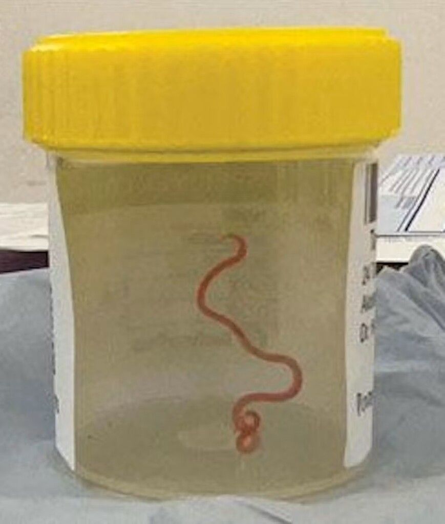 Ärzte entdecken lebendigen Wurm im Gehirn einer Frau