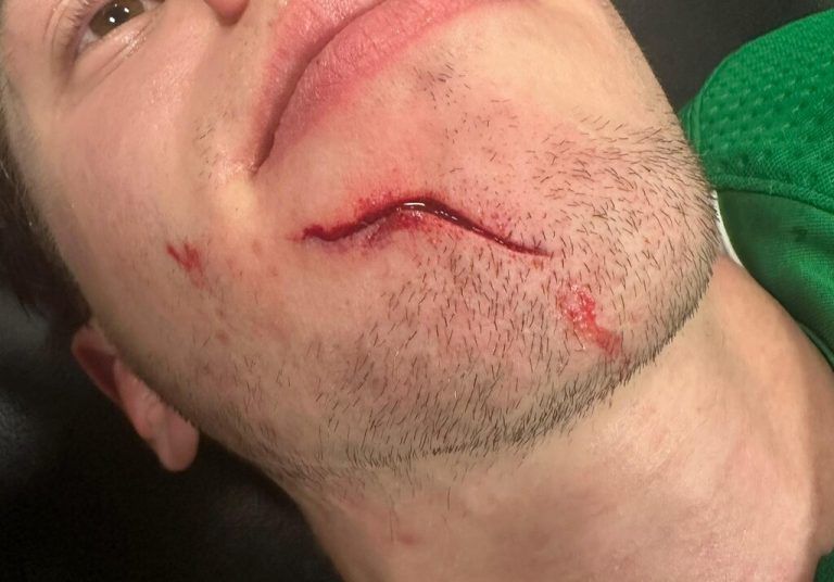 Die Schnittwunde am Kinn von Marco Rossi musste mit 27 Stichen genäht werden.