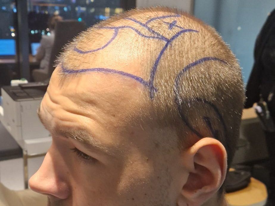 Der Kampf gegen Haarausfall und Selbstzweifel