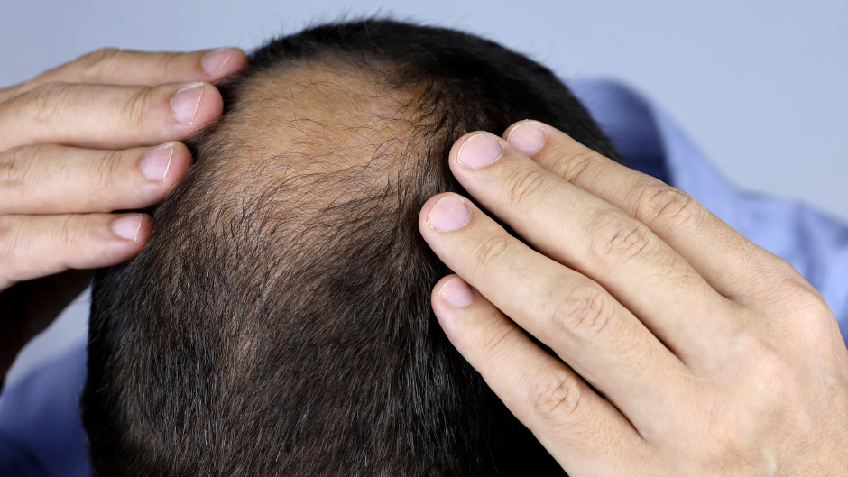 Umfrage: Wie gehen Männer in Vorarlberg mit Haarausfall um?